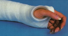 Orthopool Thumb Ring On Patient